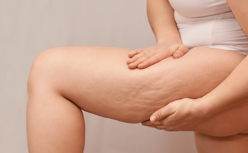 La cellulite? Questions et réponses