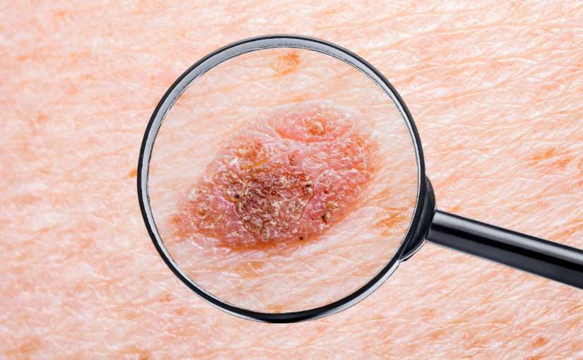 Carcinomes, mélanomes… quels sont les cancers de la peau (Le Mag – RadioFr) ?