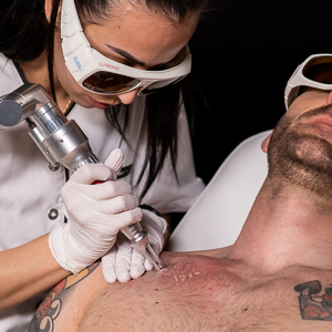 Lasers picosecondes - Détatouage