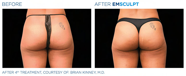 Evolys - Emsculpt fesses