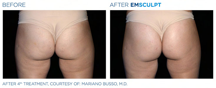 Evolys - Emsculpt fesses